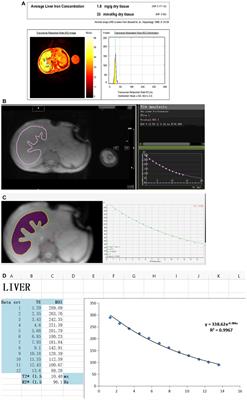 Narrative review of magnetic resonance imaging in quantifying liver iron load